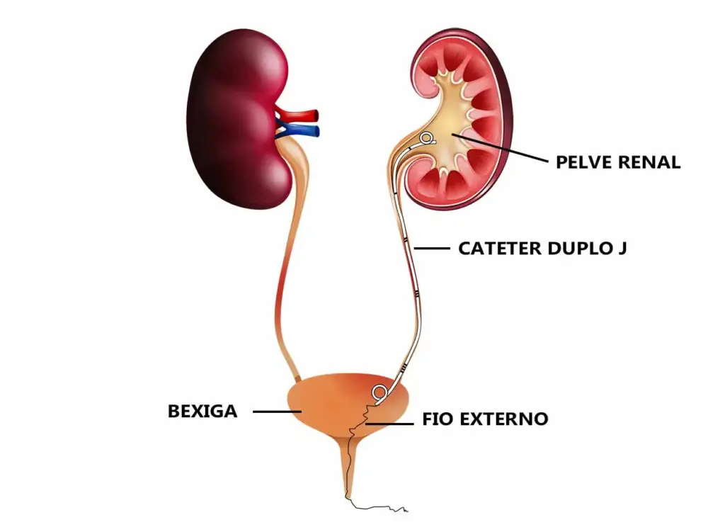 Ilustração simples do cateter duplo J no trato urinário 