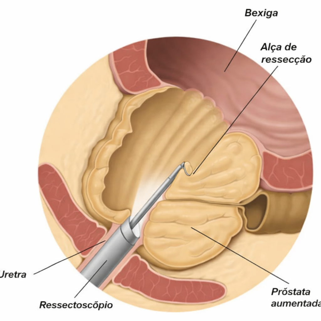 Consulta médica para avaliação de sintomas urinários relacionados à próstata aumentada e raspagem da próstata