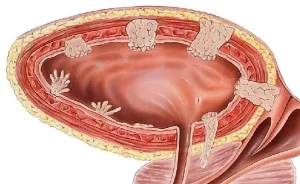 Ilustração do câncer de bexiga e avaliação com urologista em Atibaia