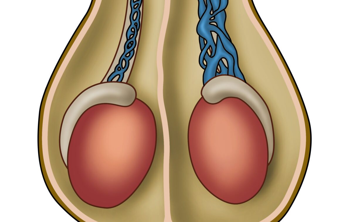 Ilustração da varicocele e avaliação com urologista em Atibaia