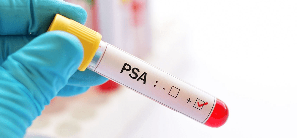 Exame de PSA alto e avaliação com urologista em Atibaia