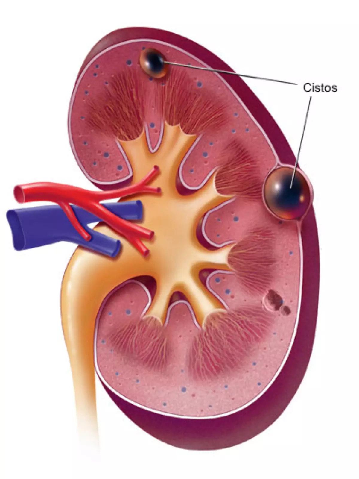Ilustração de cisto renal em exame de imagem urologista atibaia