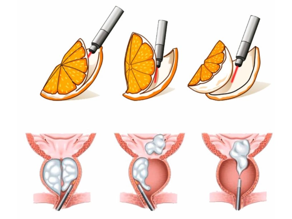 HoLEP, cirurgia a laser da próstata, urologista em Atibaia