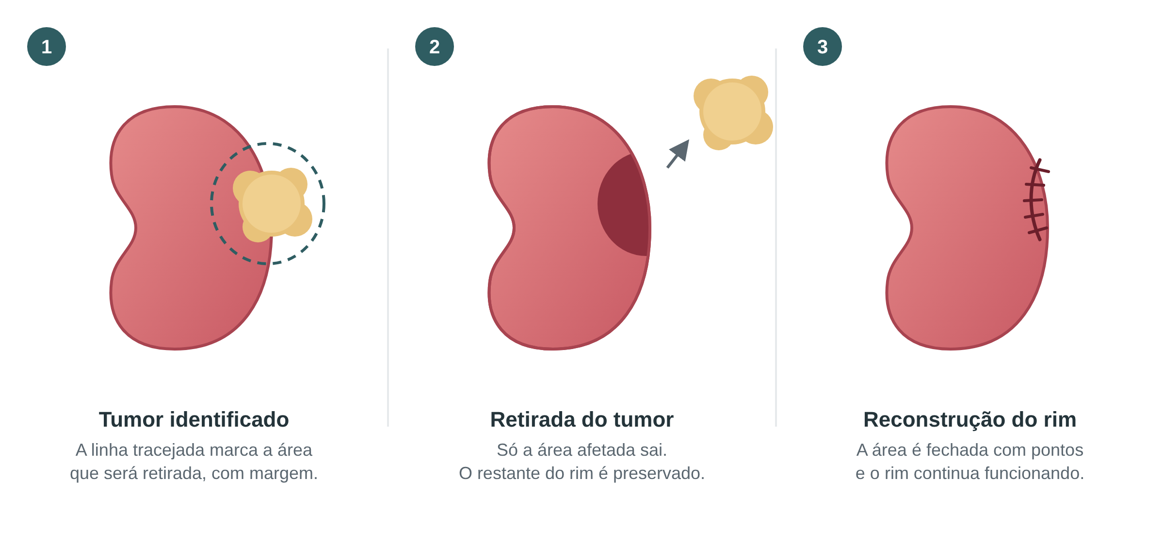 Esquema em três etapas da nefrectomia parcial, com a marcação do tumor, a retirada da área afetada e a reconstrução do rim com pontos - urologista em atibaia
