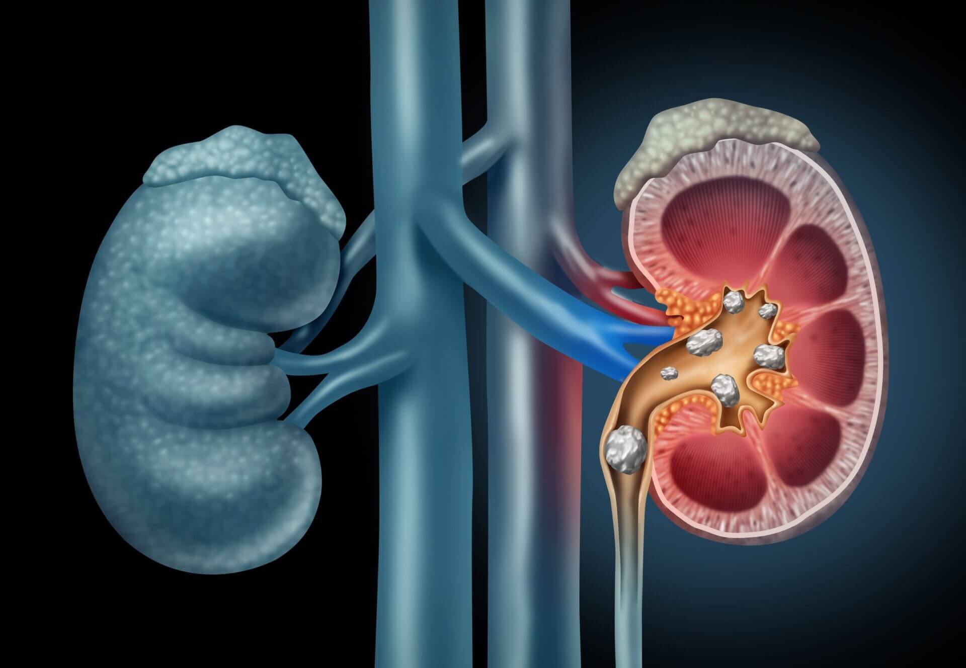 perda no rim, ureteroscopia, laser para pedra no rim urologista em Atibaia
